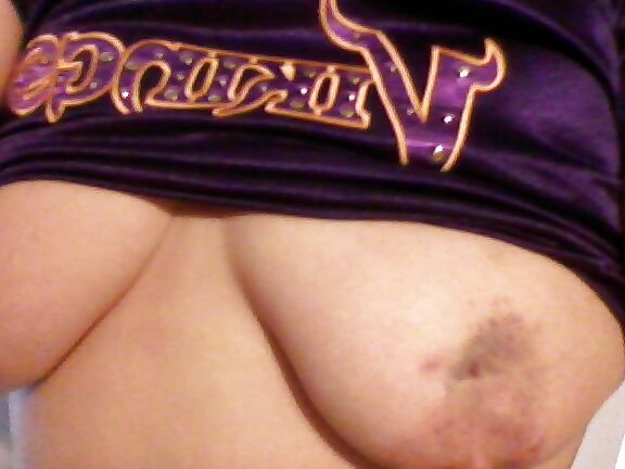 Bruises