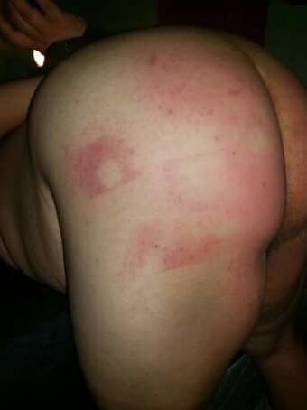 Bruises