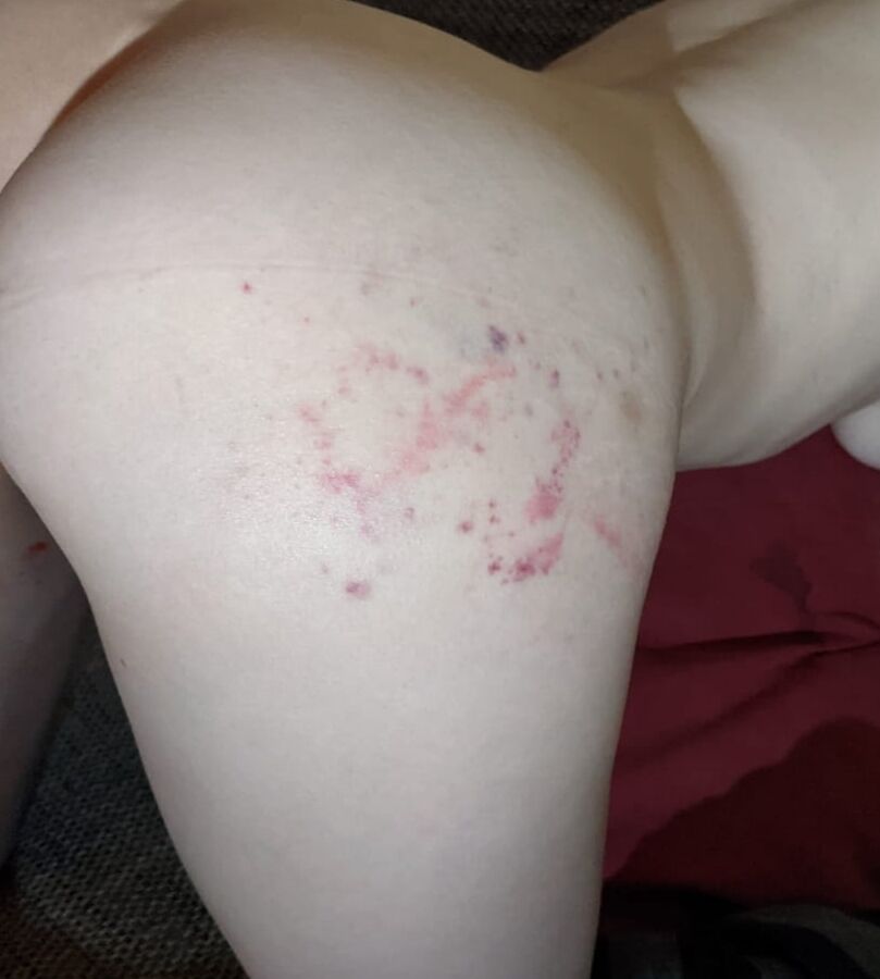Marks on my Body