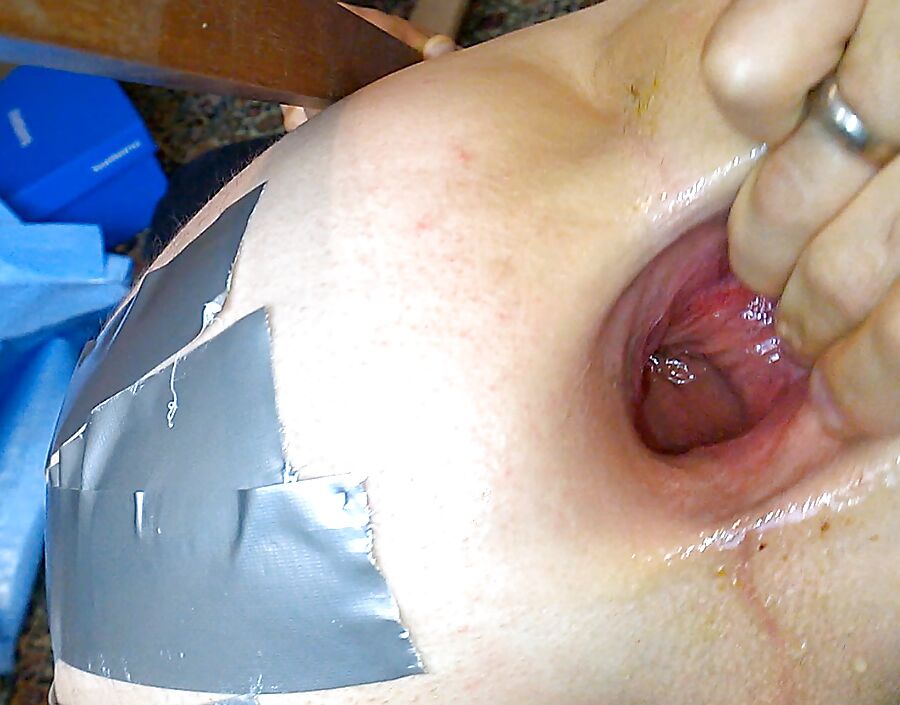 Five to eight-GAPE