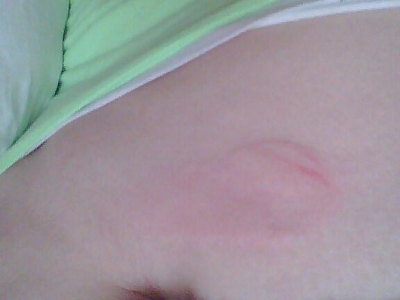 bruises