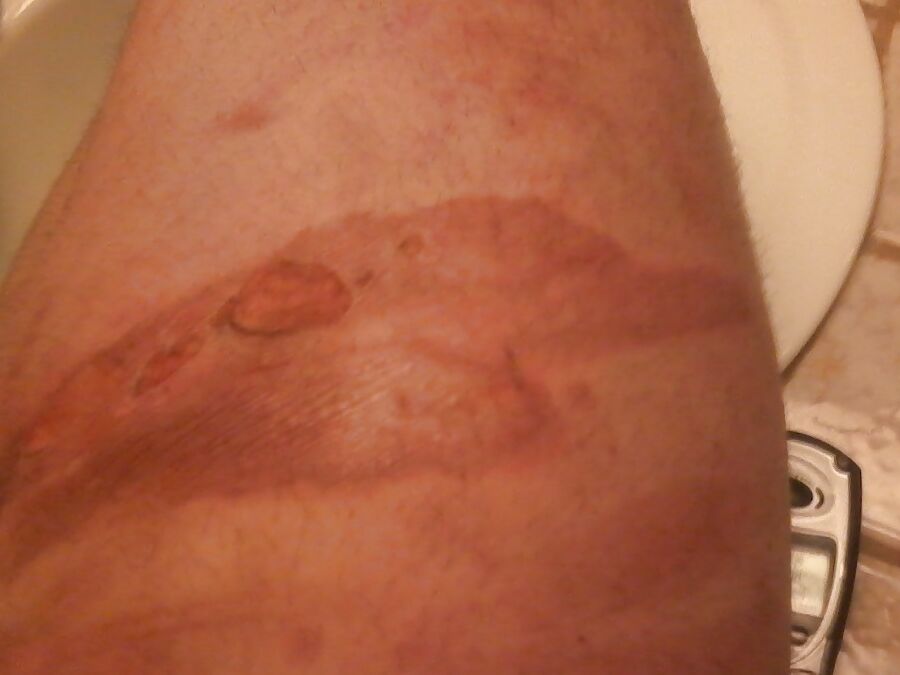 recovering