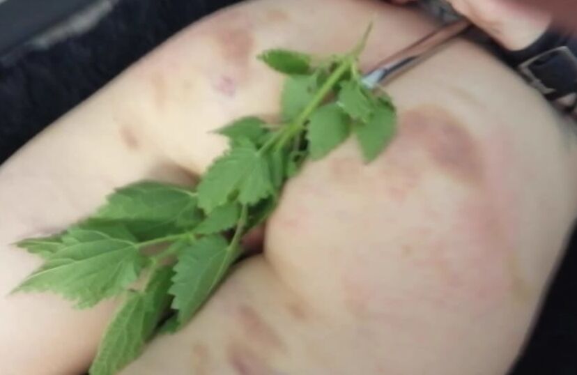 bruises