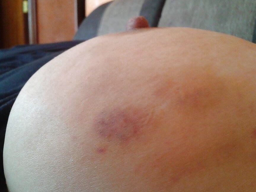 bruises