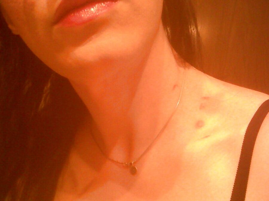 bruises