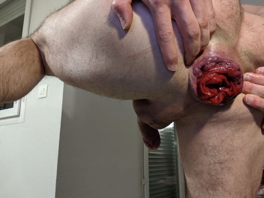 Prolapse Training
