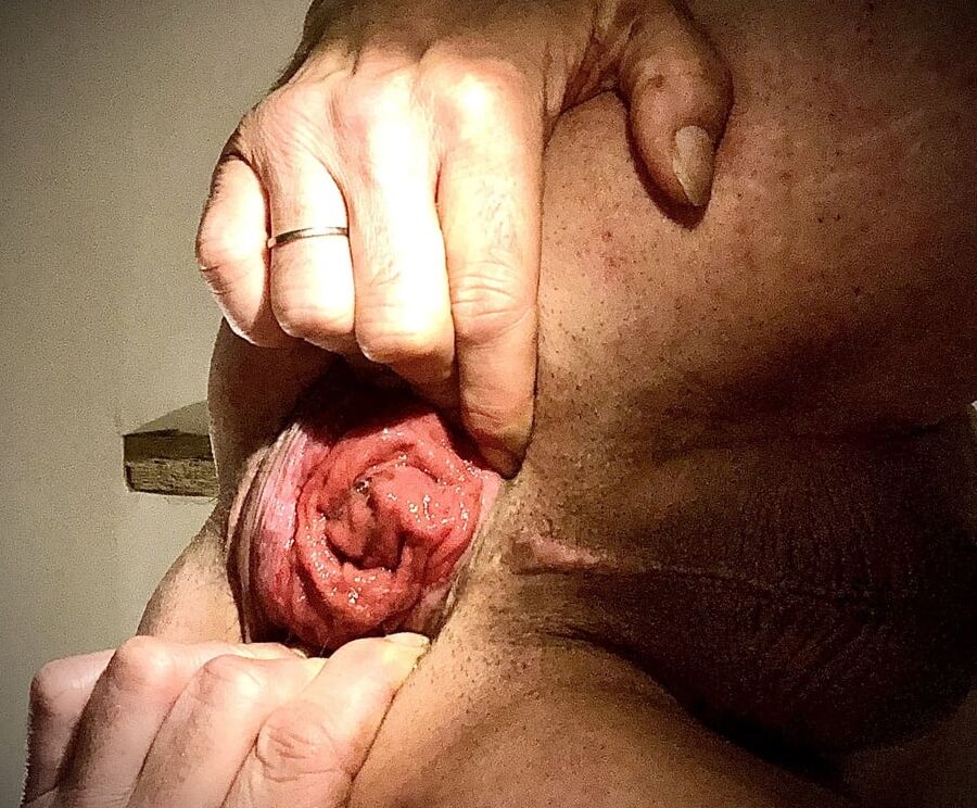 anal dilation after big insertion