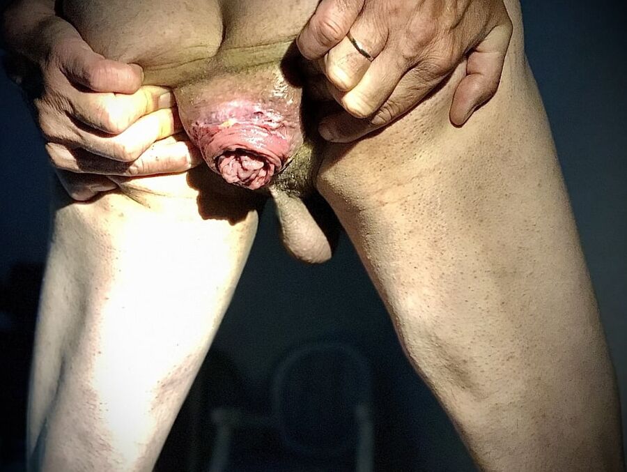 dilatation and anal prolapse