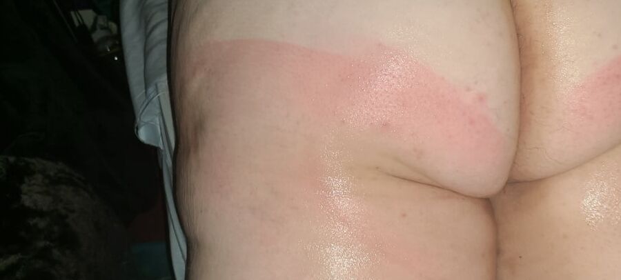 Sun burn