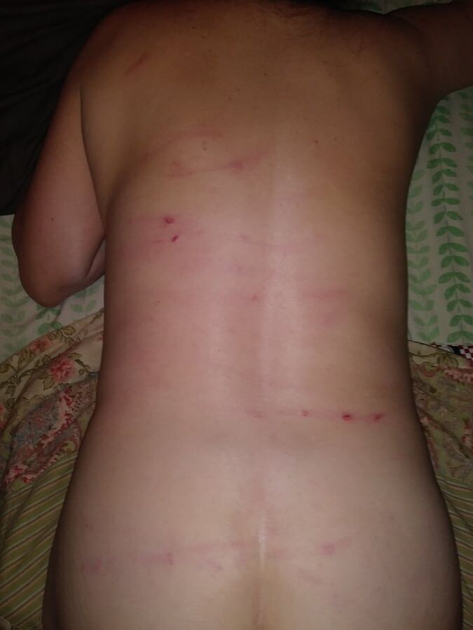 Marks & Bruises