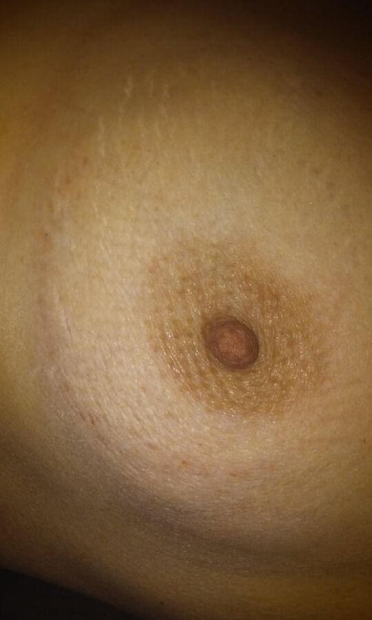 Marks & Bruises