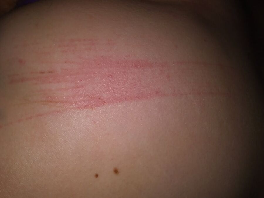Marks & Bruises