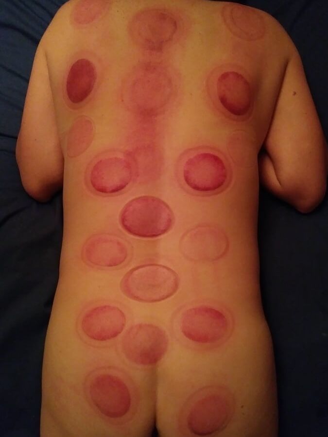 Marks & Bruises