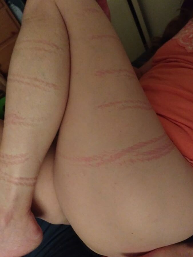 Marks & Bruises