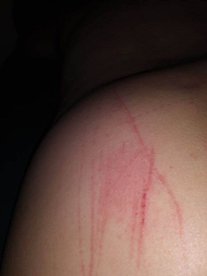 Marks & Bruises