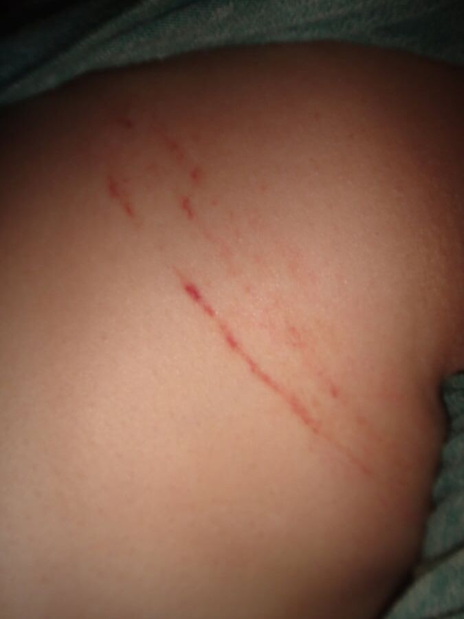 Marks & Bruises