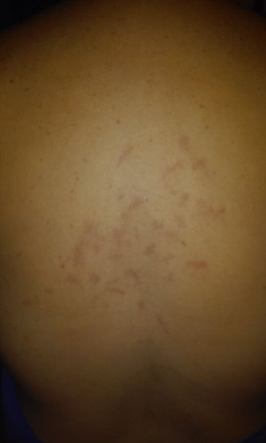 Marks & Bruises