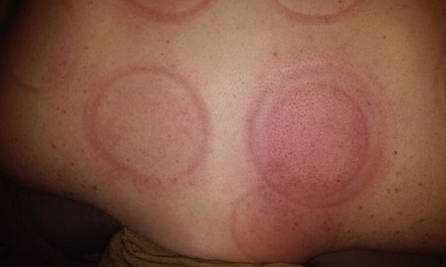 Marks & Bruises