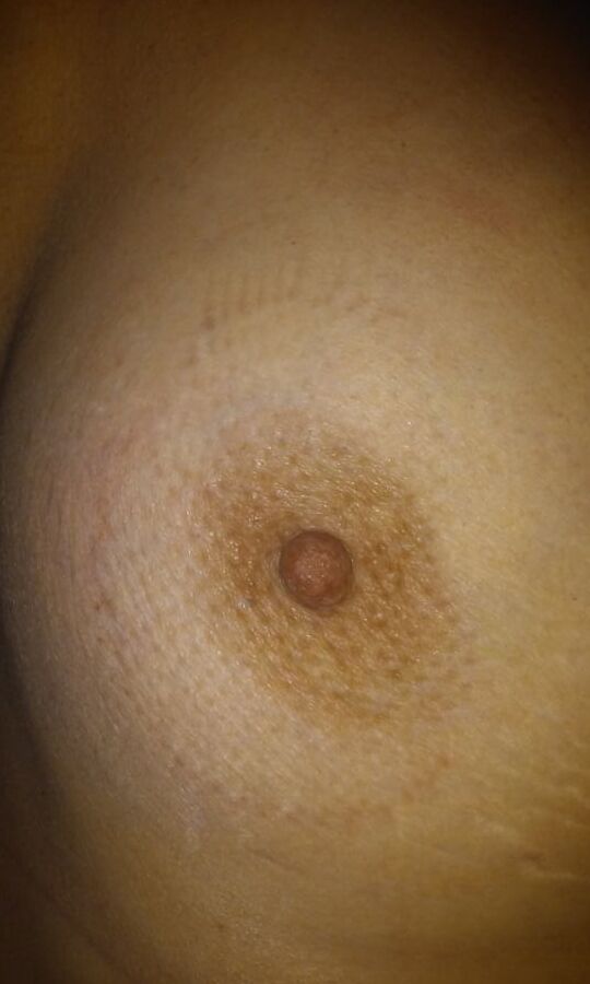 Marks & Bruises