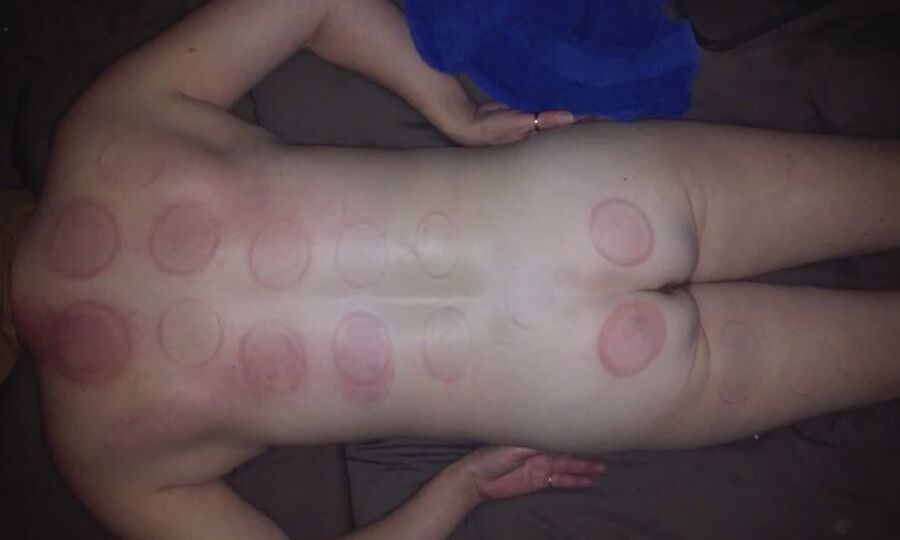 Marks & Bruises