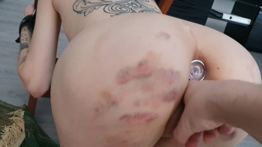 Bruises