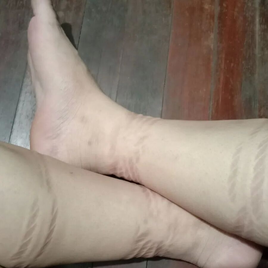 Rope marks