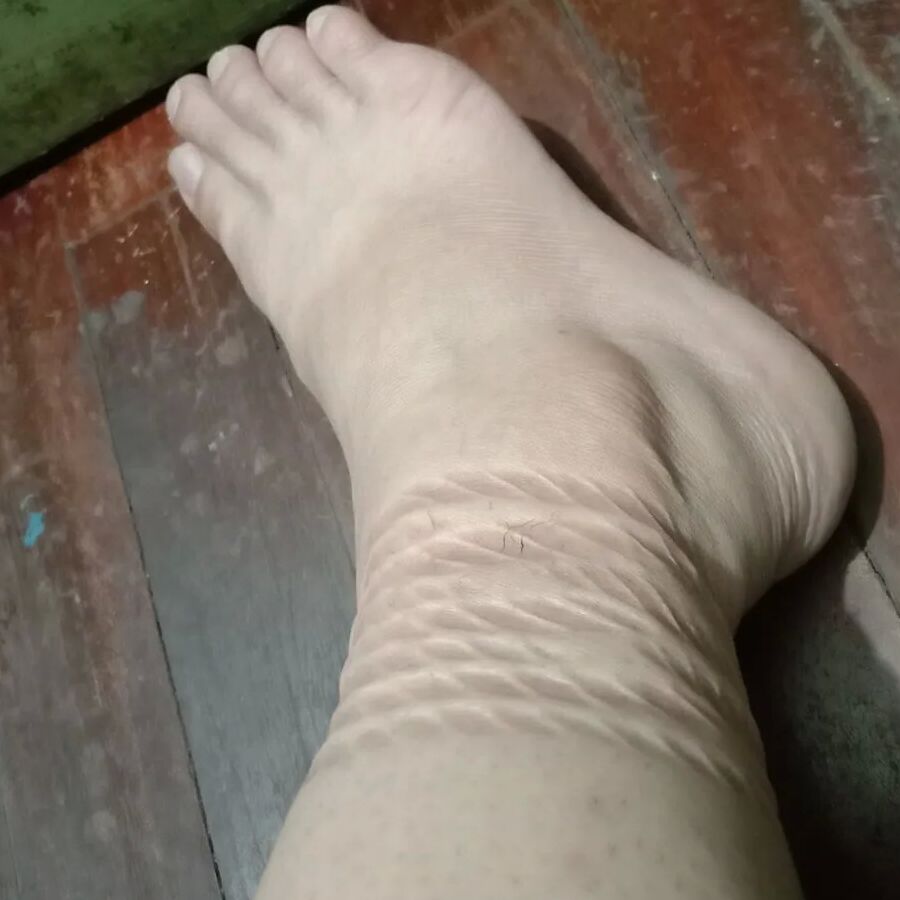 Rope marks