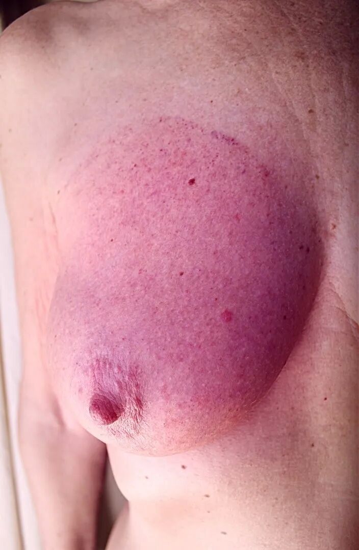 Breast vacuum cups, and stains next day - 9 Pics