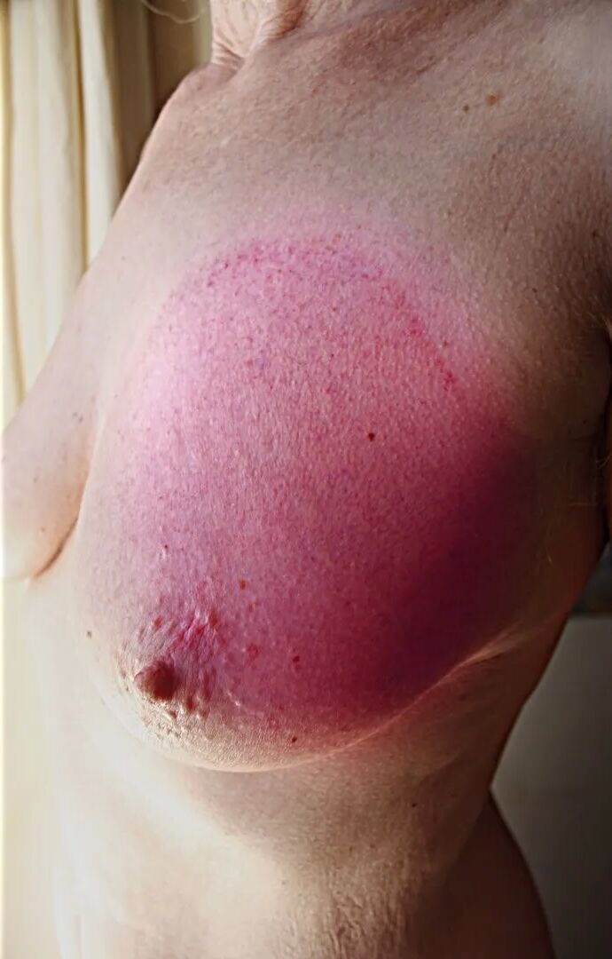 Breast vacuum cups, and stains next day - 9 Pics