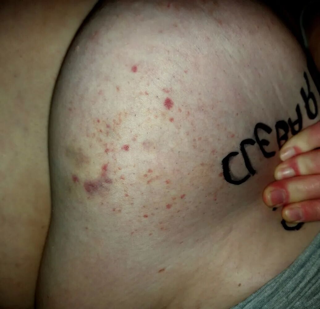Quelques marques de mon Maitre sur mes mamelles - 5 Pics