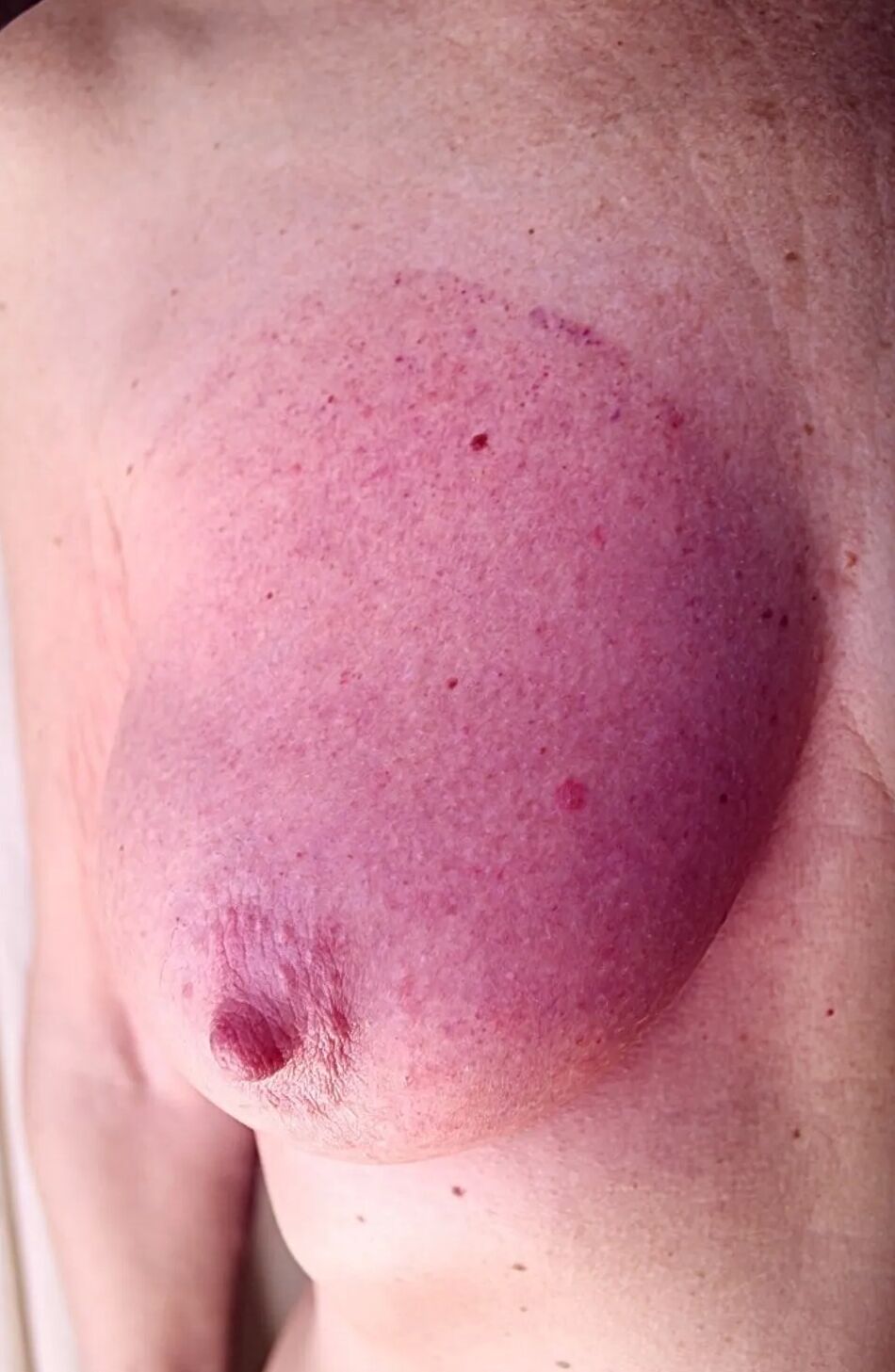 9 Pics breast vacuum cups, and stains next day