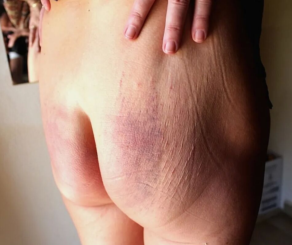 5 Pics cropped ass next morning