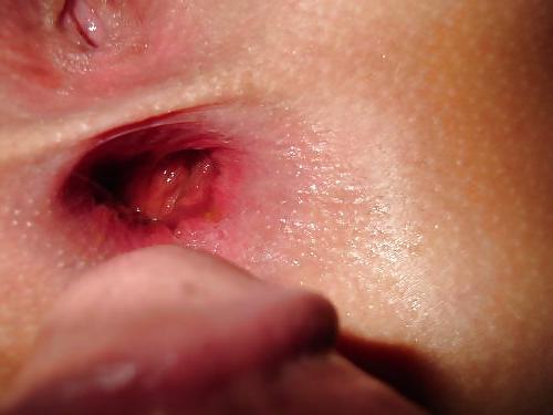 15P Amateur anal