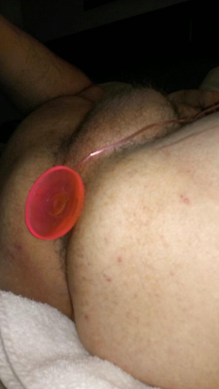 10P Anal 