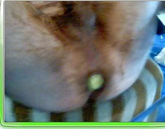 25P Anal