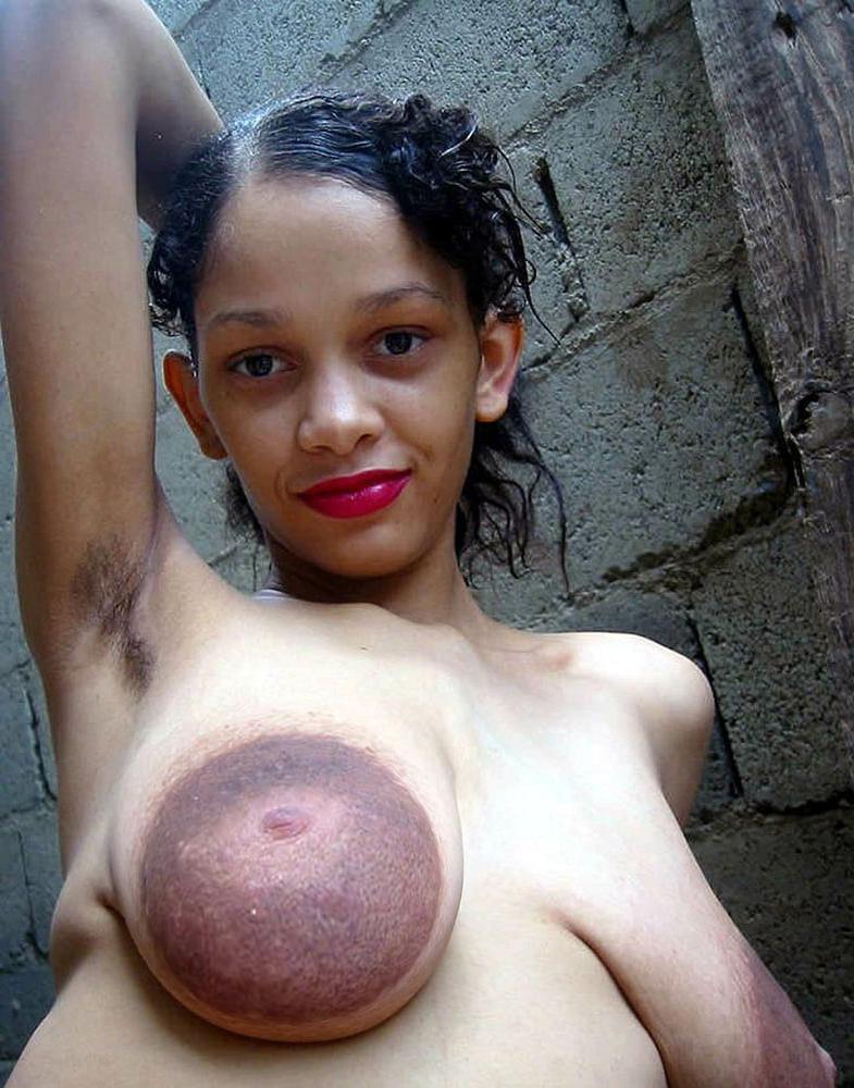12P Huge areolas