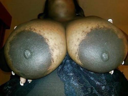 12P Huge areolas