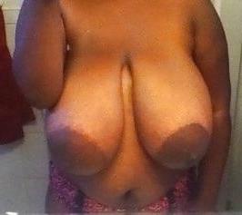 12P Huge areolas