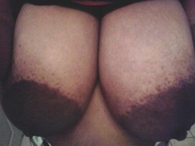 12P Huge areolas