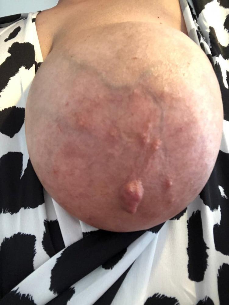 12P Huge areolas