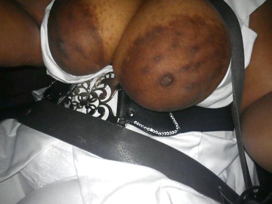 12P Huge areolas