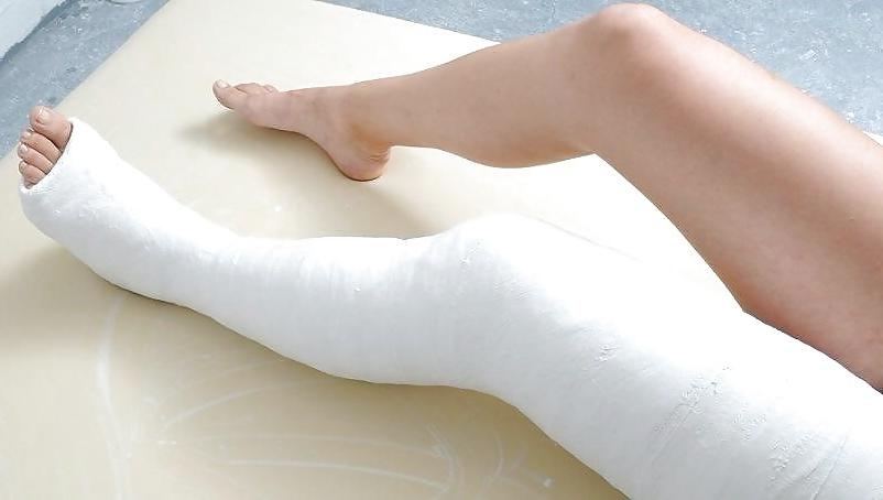 10P Leg cast fetish