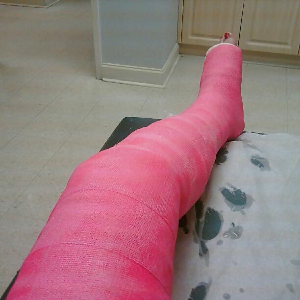 10P Leg cast fetish