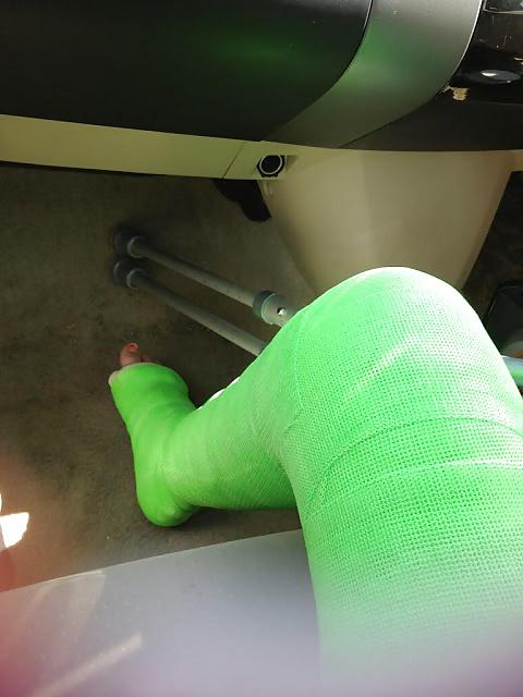 10P Leg cast fetish