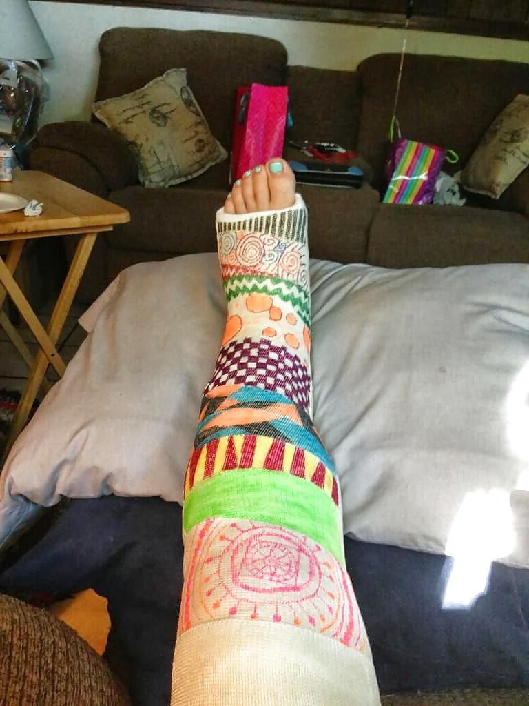 10P Leg cast fetish