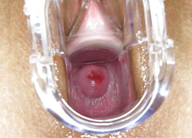 25P Speculum