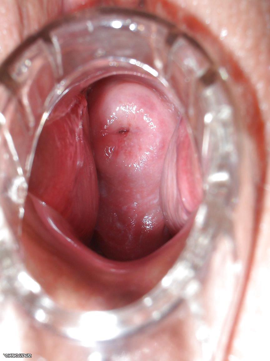 8P Speculum