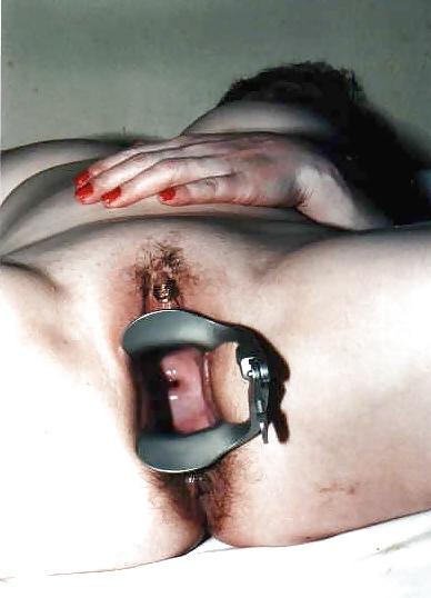 18P SPECULUM SPREDING