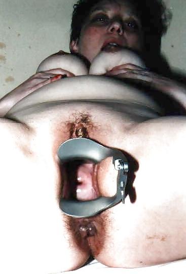 18P SPECULUM SPREDING
