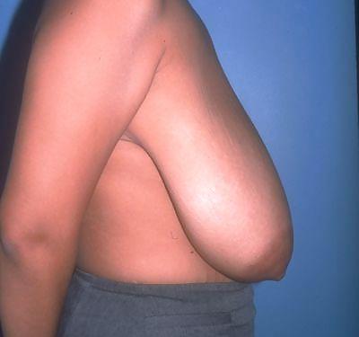 25P Big Natural And Saggy Tits Pre-OP Pictures